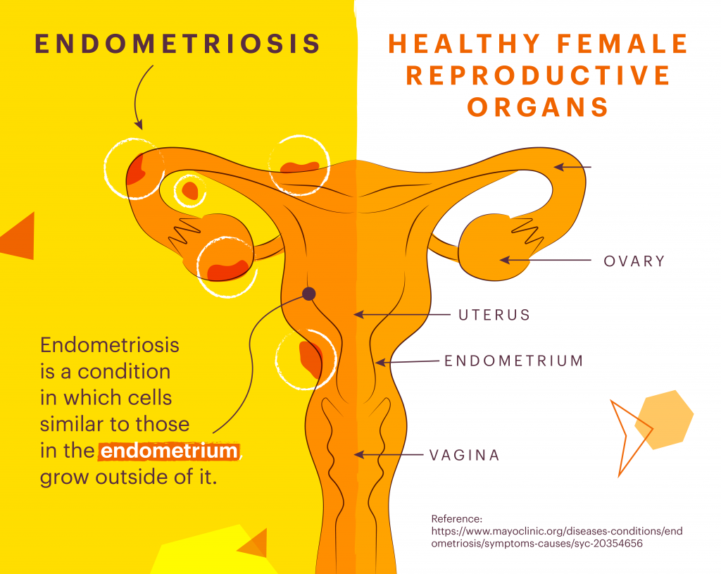 What is endometriosis diagram