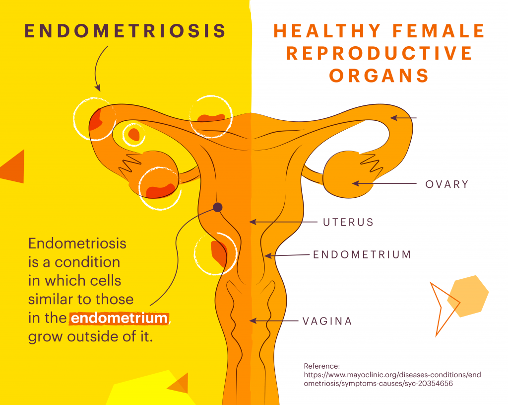 Endometriosis Diagram