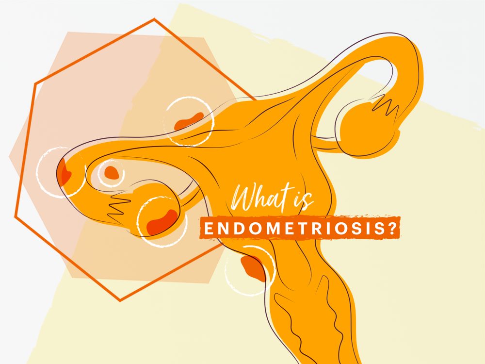 Endometriosis Campaign Onyx Health